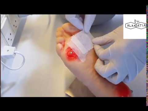 احدث لزقات علاج الجروح باستخدام دم المريض