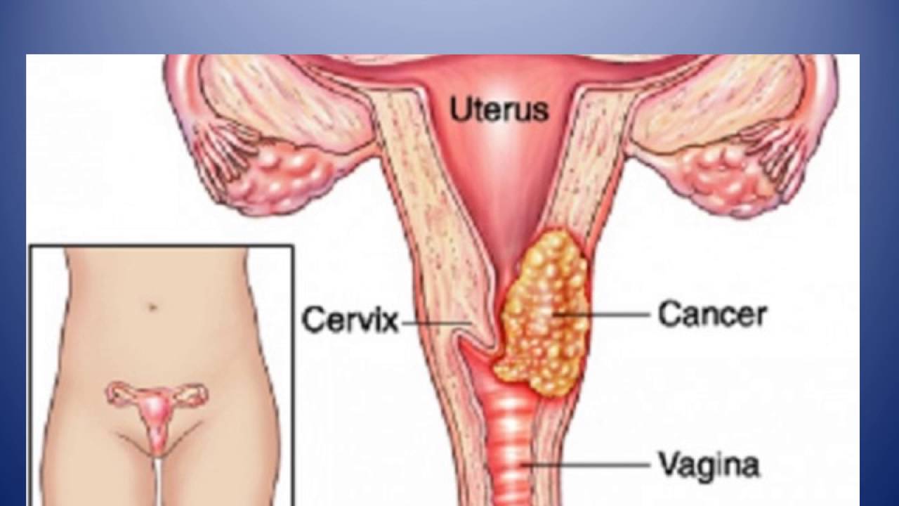 10 Enfermedades Del Sistema Reproductor Femenino www.youtube.com