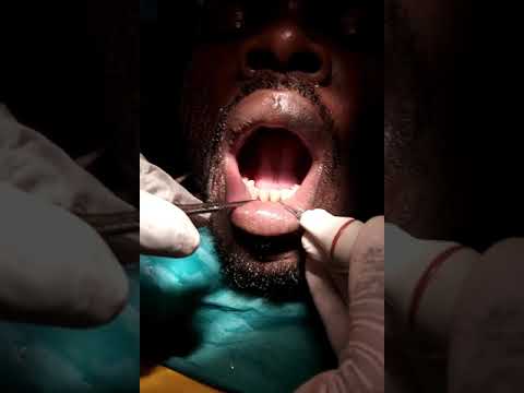Vidéo: Définition Des Signatures Fonctionnelles De La Dysbiose Dans La Progression De La Parodontite