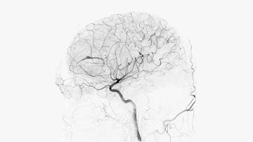 Developmental Venous Anomaly Inside a Glioblastoma