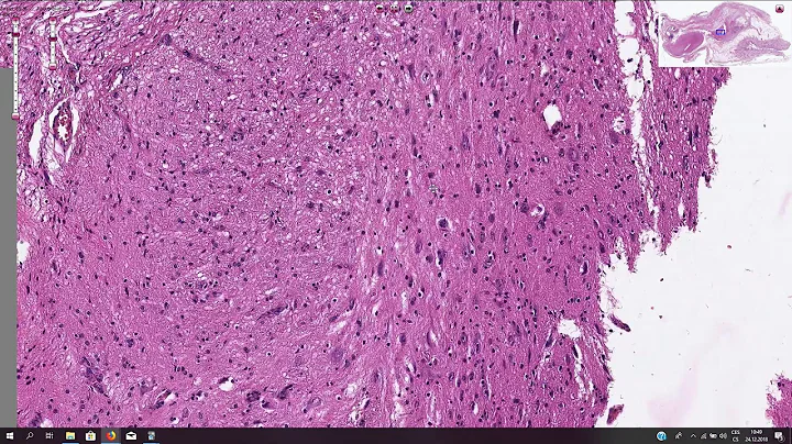 Mature Teratoma, Ovary - Histopathology - DayDayNews