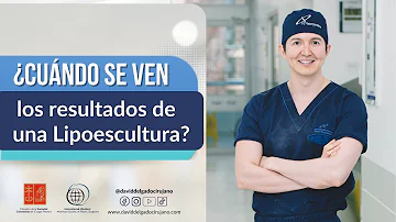 ¿Qué esperar 6 semanas después de la liposucción?