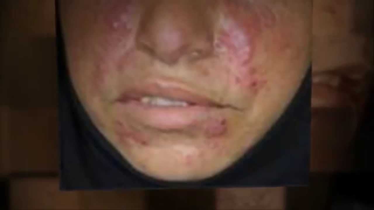 Rosacea Treatment Photos | Rosacea.org