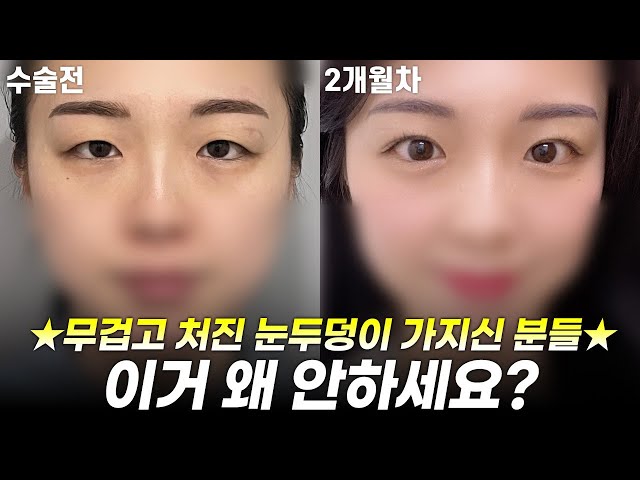 코 재수술로 더욱 선명해진 코 라인 확인✔ #코성형 #절개눈매교정 #눈성형