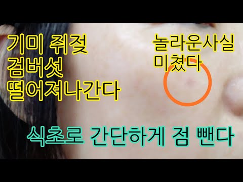 식초로 점빼기/점 쥐젖 편평사마귀/검버섯 주근깨 빼는방법/집에서 쉽고 간단하게 없애자 식초와 밀가루 민간요법으로 간단하게 쏙! 빠진다