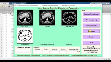 Matlab Code for LIVER CANCER DETECTION Using Image Processing