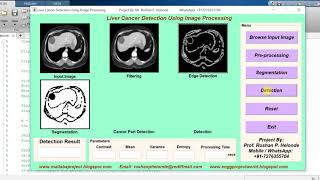 Matlab Code for LIVER CANCER DETECTION Using Image Processing
