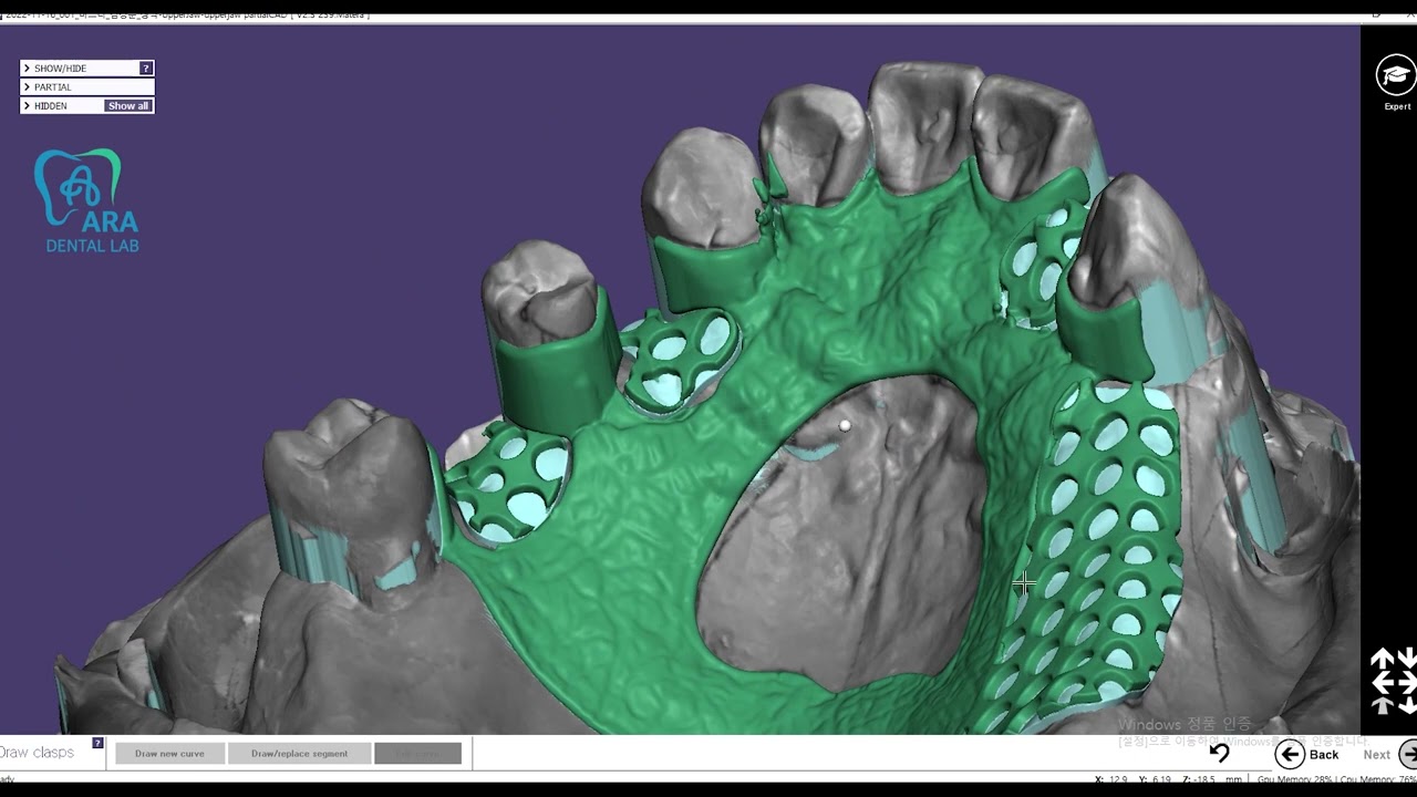 A-P bar type partial frame design
