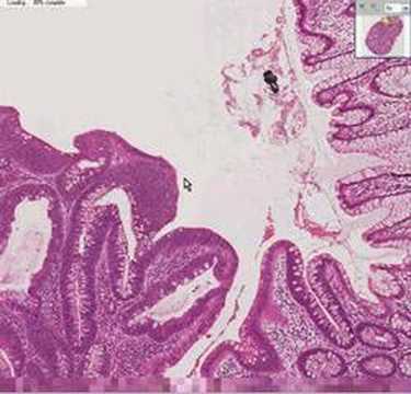 Cos'è un adenoma tubulare?