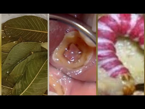Sakit Gigi Berlubang Hilang Dengan Daun Pandan. 