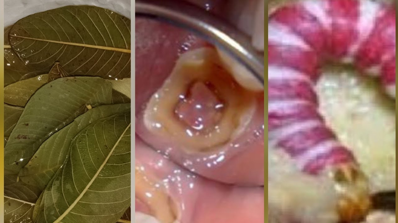Atasi Ulat Dan Gigi Berlubang Hanya Dengan Rebusan Daun Jambu Biji