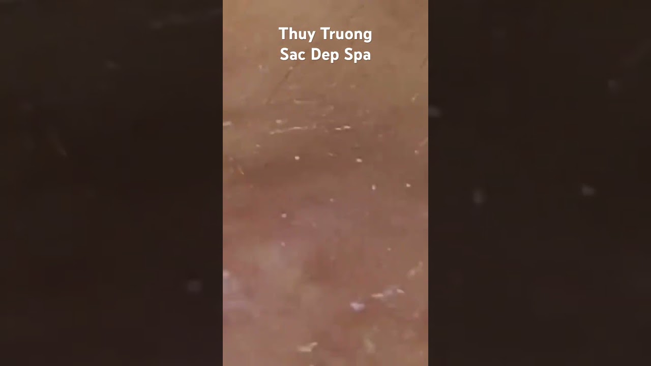 Acne #sacdepspa #thuytruong #trimun