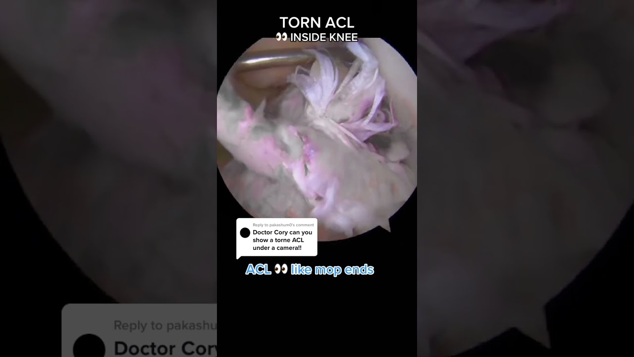 ACL Inside The Knee Torn Vs NEW Shorts