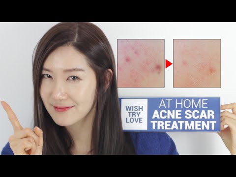 How to Get Rid of Acne Scars Fast? At Home Acne Scar Treatment | Wishtrend