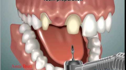 Animation on a Fixed Bridge