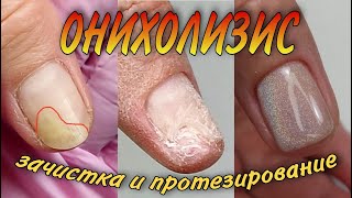 видео: онихолизис\зачистка и протезирование картинка: онихолизис\зачистка и протезирование