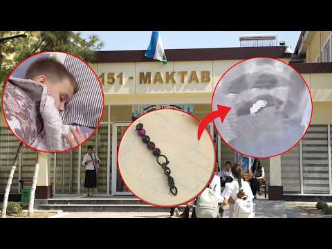 Temir bilaguzuk yutgan o‘quvchi | 151-maktab