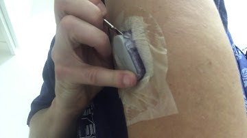 Removing Dexcom G6 transmitter from sensor