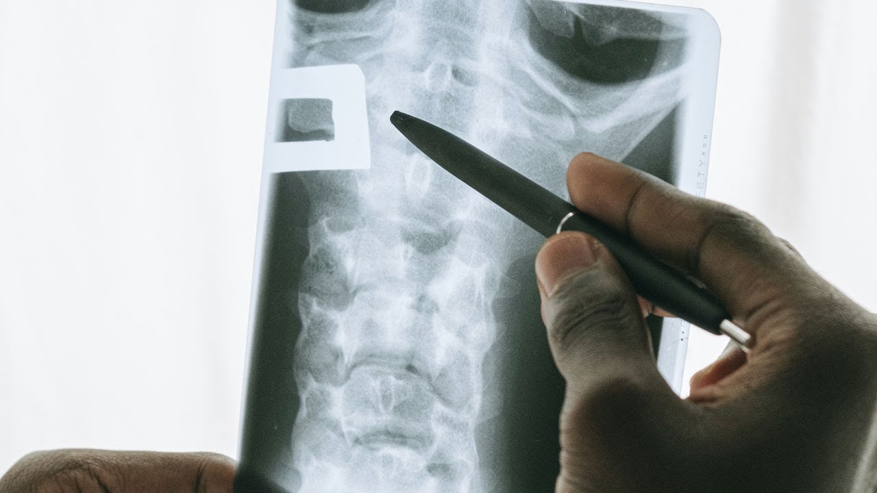 I farmaci per l’osteoporosi e la loro prescrizione