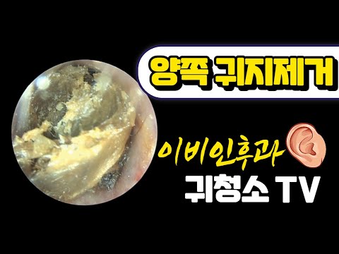 양쪽 귀지 제거 (Cerumen Impaction)