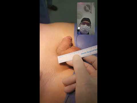 Penile enlargement surgery - Penis surgery - Dr . Araz Bayramov