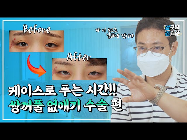쌍꺼풀없애는수술 실제 환자 사례로 결과 보여드릴께요