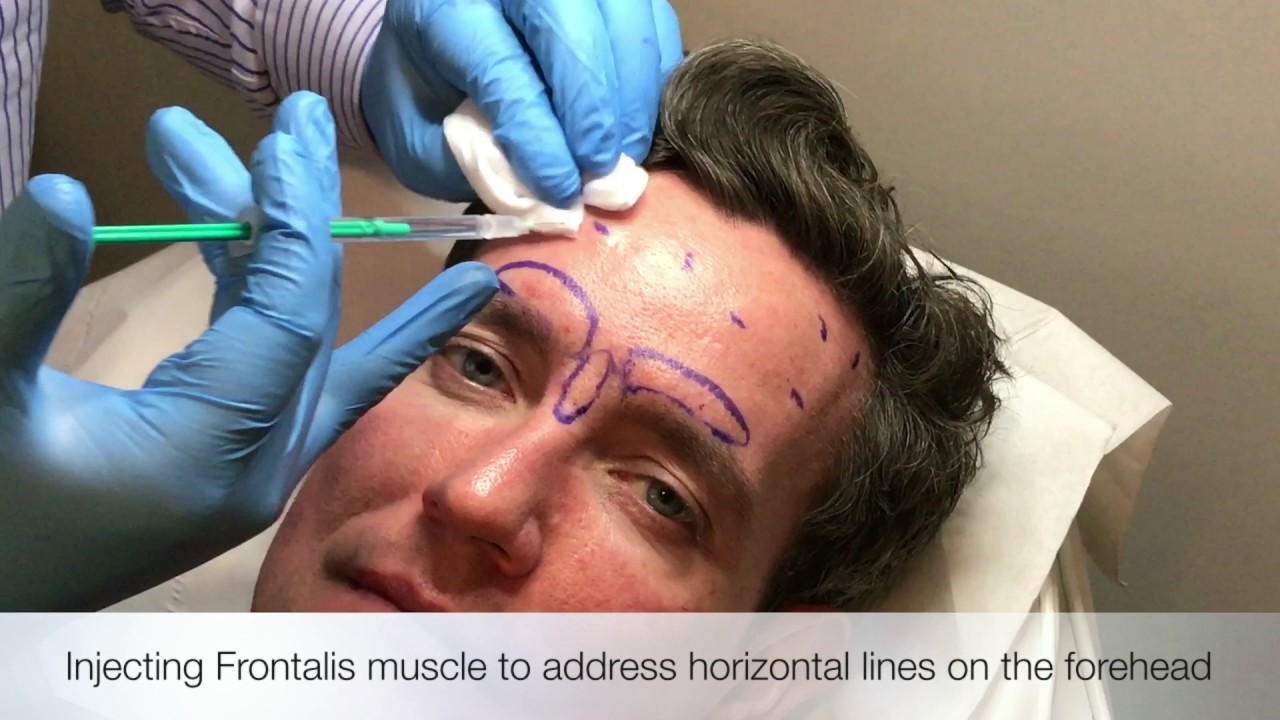 injecting frontalis muscle youtube