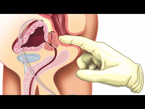 Vídeo: Prostatitis O BPH: ¿cuál Es?