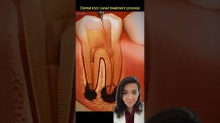 Uncovering the Mystery Behind Root Canal Treatment