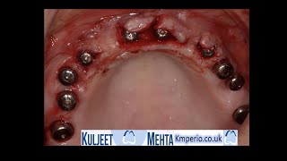 Soft Tissue management during Implant Exposure by Dr Kuljeet Singh Mehta-Periodontist 3,485 views 2 years ago 6 minutes, 45 seconds