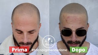 Tricopigmentazione Prima e Dopo - Risultati screenshot 3