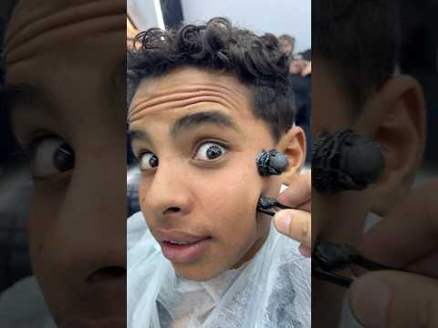 ازالة الحباية المتسلطنة من الخد