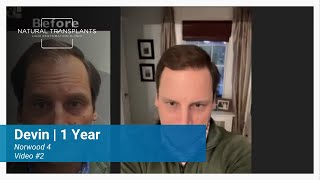 Norwood 4 Hair Transplant: 1-Year Results & Natural Growth | Dr. Blumenthal (Devin)