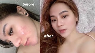 ACNE JOURNEY: how i get rid of my acne *clear skin*