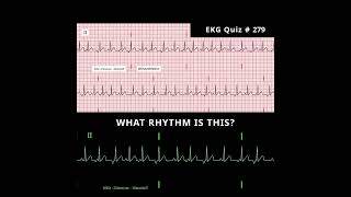 Test Your EKG Skills ⚡ Guess the Rhythm!