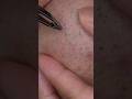 065 #tweezers #hairremoval #毛抜き