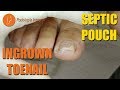 ⏯🔶Ingrown toenail with septic pouch [Podología Integral] Integral Podiatry🔶