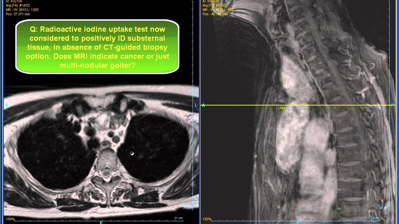 Ct And Mri Scans Of Female 68 Yr Old W Large Substernal Multinodular