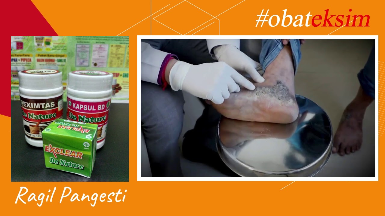 Cara mengobati EKSIM kering dengan cepat, Obat EKSIM kering paling