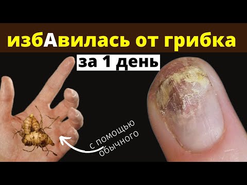 ГРИБОК НОГТЕЙ убрала за 15 минут обычной смесью, каждый найдёт дома.