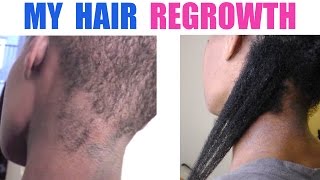 Hair Regrowth | Coconut Oil or Shea Butter Mixture