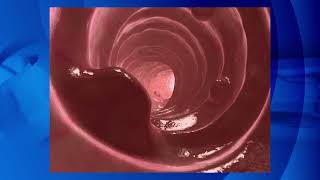 🚀 Advancements in Colorectal Polyp Removal: Cold Snare Polypectomy (#CSP) is Gaining Ground!