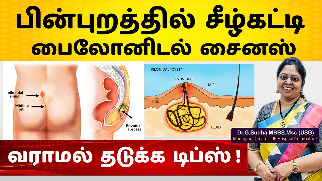 Pilonidal Disease  Causes in Tamil பின்புறத்தில் சீழ்கட்டி சீழ்கட்டி -வராமல் தடுக்க டிப்ஸ்.
