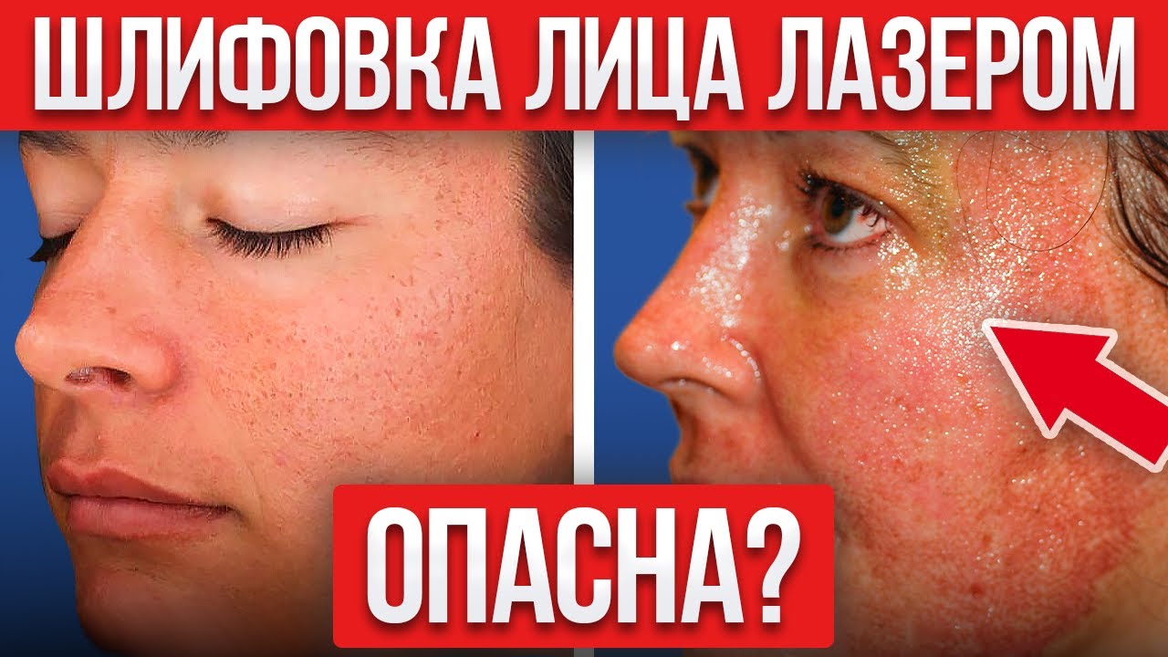 Как избавиться от шрамов и рубцов НАВСЕГДА? / Все о лазерной шлифовке от А до Я!