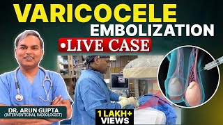 Live Case - Grade 3 Varicocele Embolization | Non-Surgical Treatment of Varicocele | Dr. Arun Gupta