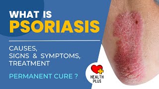 What is Psoriasis | Causes Signs Symptoms Treatment | Skin Disease | Removal and Permanent Cure