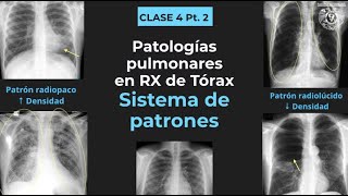 04.2 - Tórax anormal: Patrones radiológicos (consolidación, atelectasia, bula, cavitación, etc)