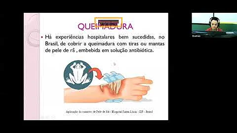 Quais os fatores usados para se determinar a gravidade de um queimadura?