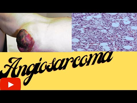 How does ANGIOSRCOMA originate, behave- EVERYTHING  in 6 minutes with case discussion-- USMLE, NEET