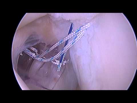 SLAP Repair: Superior Labrum Anterior Posterior